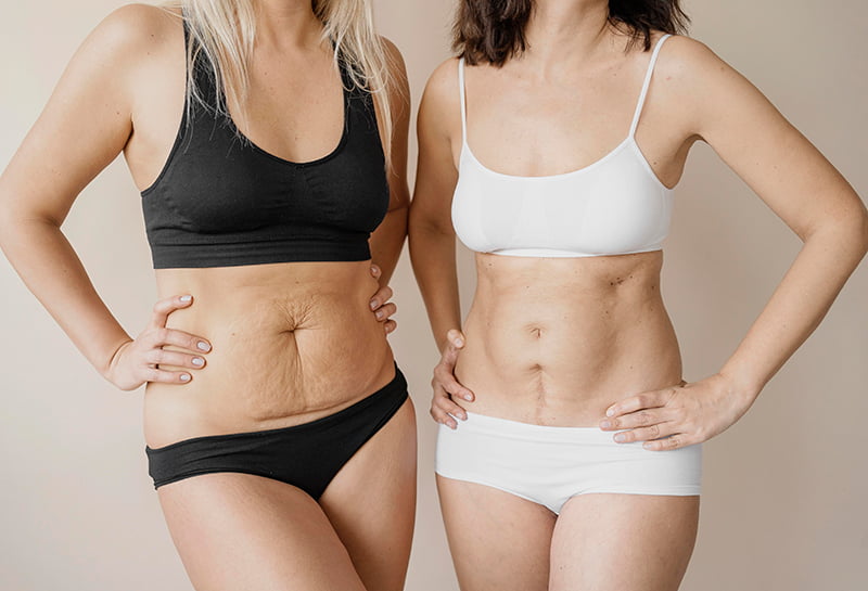 cicatrices y dermatologia - Cicatrices Dermatol&oacute;gicas: Una Gu&iacute;a Completa