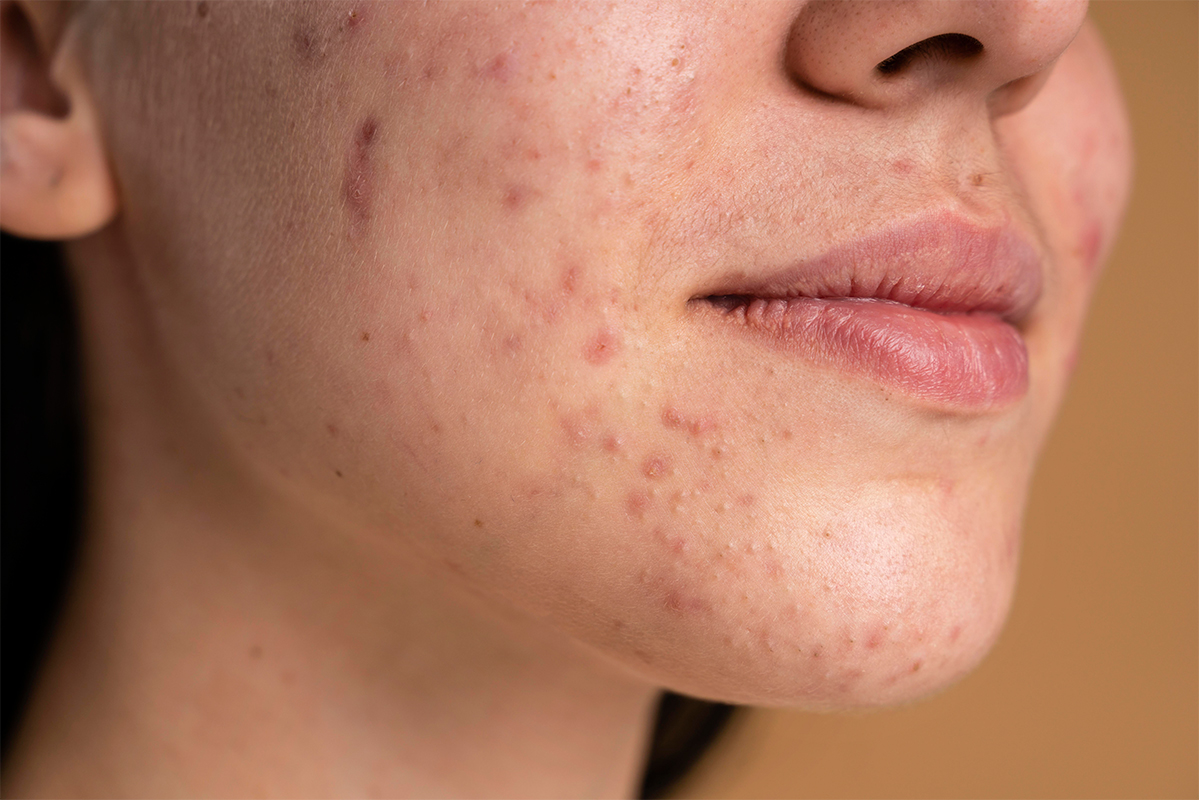 Casos Comunes Tratados por un Dermatologo en Rancagua - &iquest;Por qu&eacute; Consultar a un Dermat&oacute;logo en Rancagua es Esencial para tu Salud?
