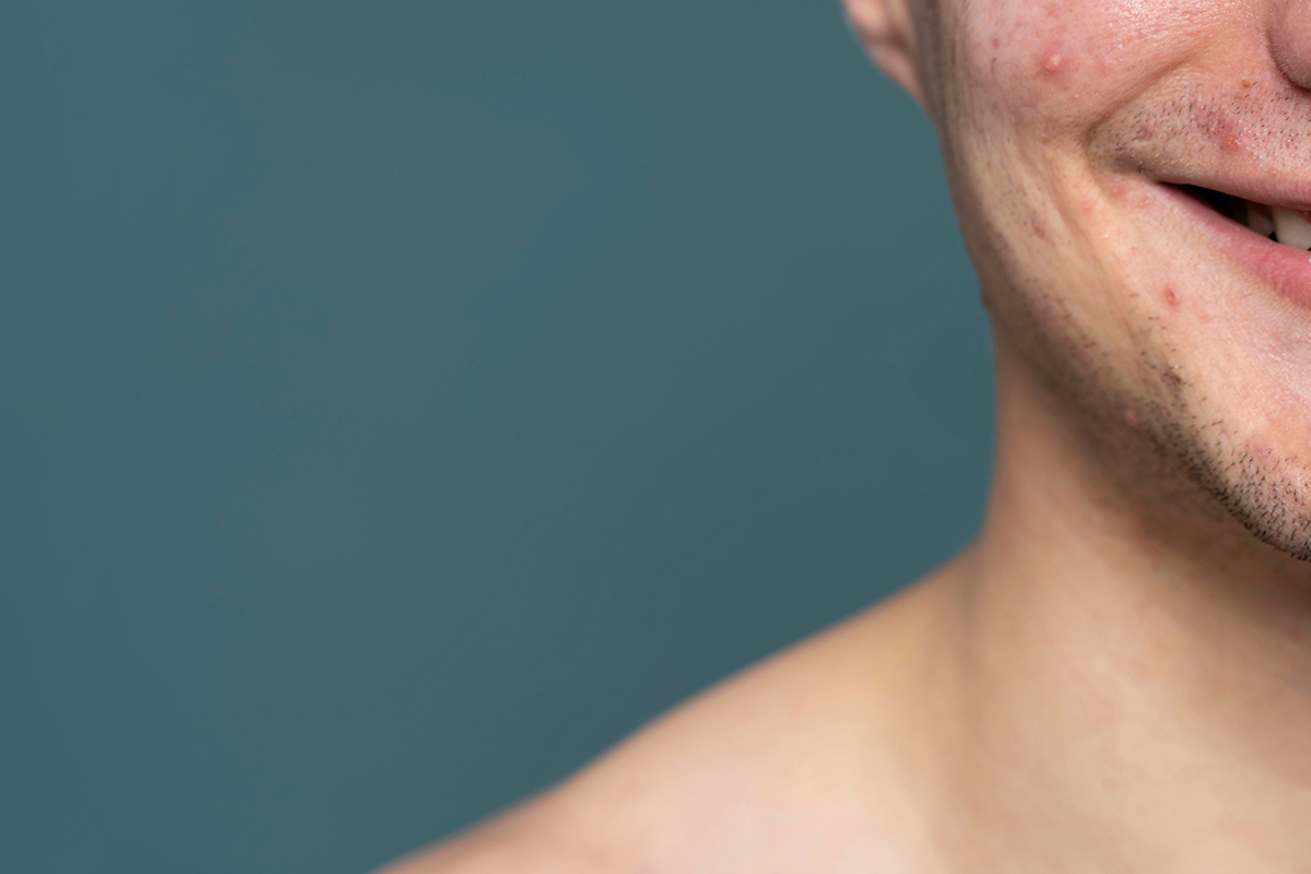 Cuidado Dermatológico en Adultos: Mantén tu Piel Saludable con un Especialista Condiciones Comunes de la Piel en la Edad Adulta - Cuidado Dermatológico en Adultos: Mantén tu Piel Saludable con un Especialista
