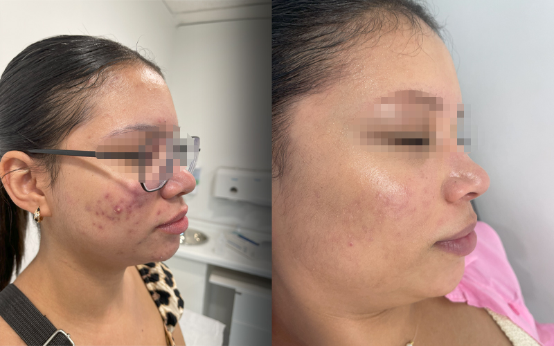 Tratamiento del Acne en Adultos - Horas Dermatol&oacute;gicas
